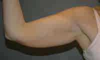 Liposuction