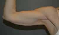 Liposuction