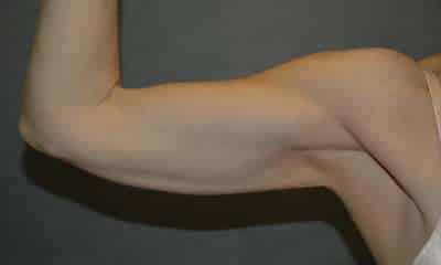 Liposuction