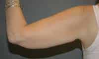 Liposuction