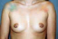 Breast Augmentation