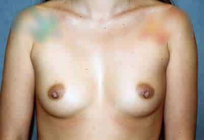 Breast Augmentation