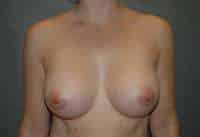 Breast Augmentation