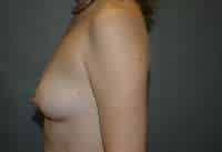 Breast Augmentation