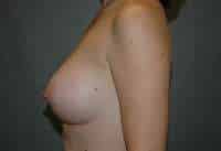 Breast Augmentation