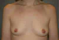 Breast Augmentation