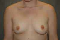 Breast Augmentation