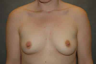 Breast Augmentation