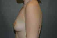 Breast Augmentation