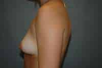 Breast Augmentation