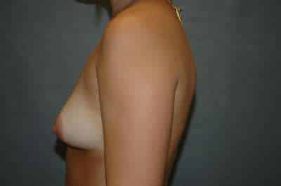 Breast Augmentation