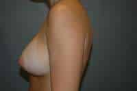Breast Augmentation