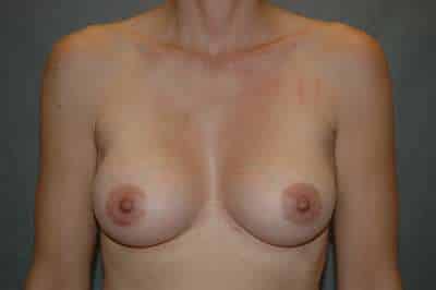 Breast Augmentation