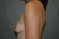Breast Augmentation