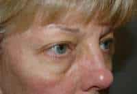 Eyelid Lift