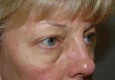 Eyelid Lift