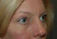 Eyelid Lift