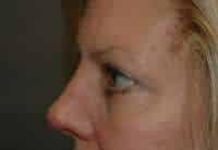 Eyelid Lift