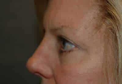Eyelid Lift