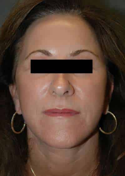 Facelift