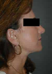 Facelift
