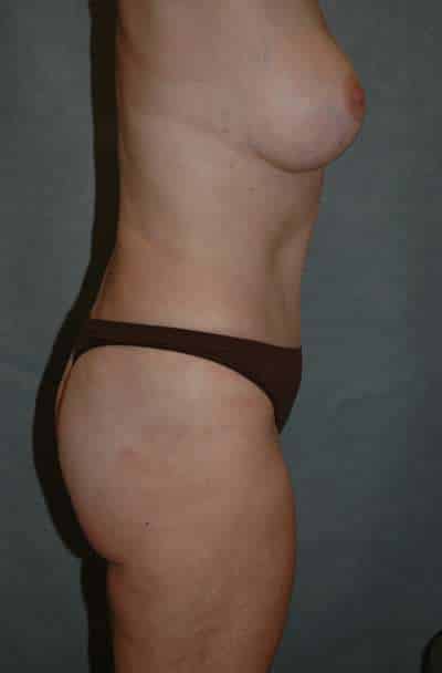 Abdominoplasty