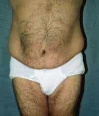 Male Belt Lipectomy