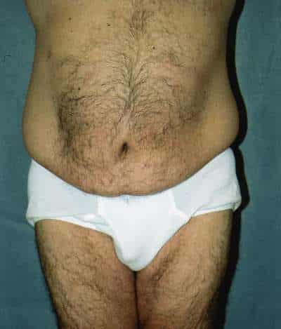 Male Belt Lipectomy