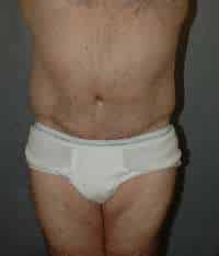 Male Belt Lipectomy