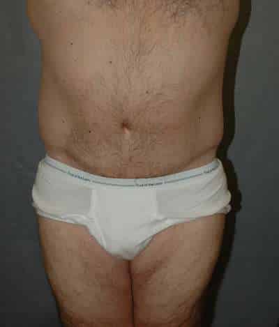 Male Belt Lipectomy
