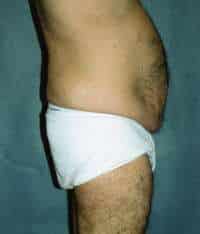 Male Belt Lipectomy