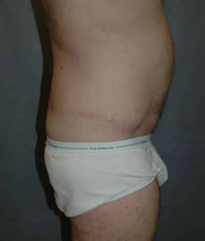 Male Belt Lipectomy