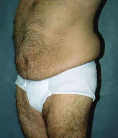 Male Belt Lipectomy