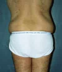 Male Belt Lipectomy