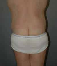 Male Belt Lipectomy