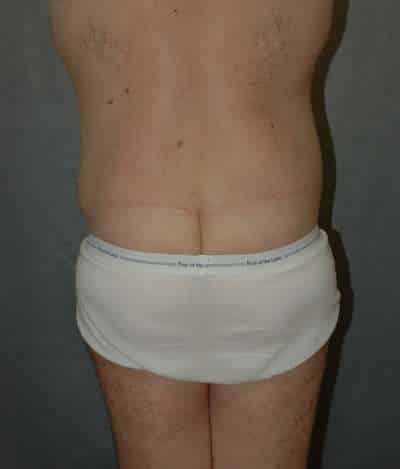 Male Belt Lipectomy