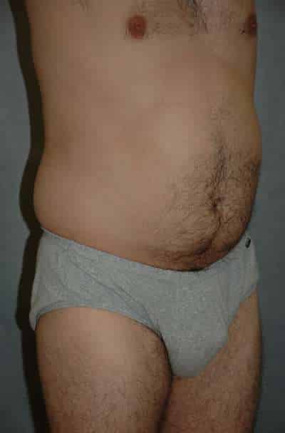 Male Liposuction