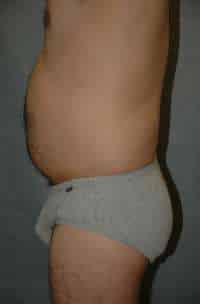 Male Liposuction