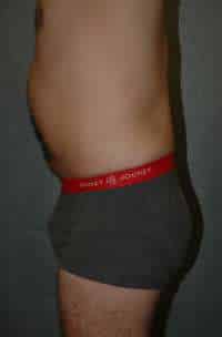 Male Liposuction