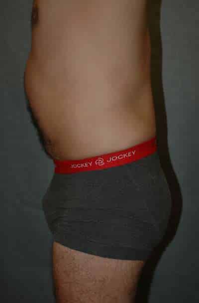 Male Liposuction