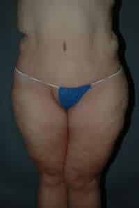 Belt Lipectomy