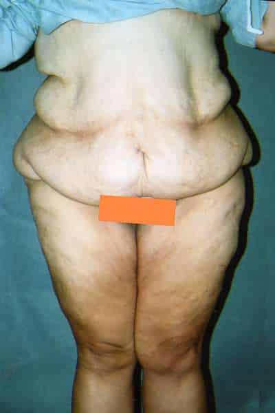 BELT LIPECTOMY Before and After Results