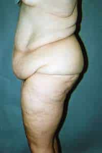 Belt Lipectomy