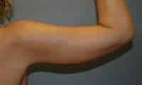 Arm Lift