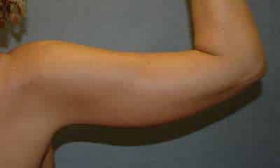 Arm Lift