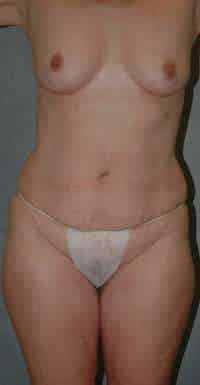 Abdominoplasty