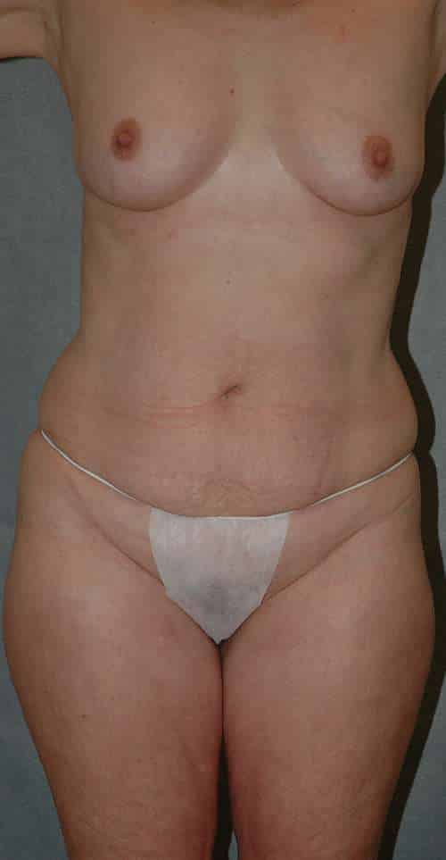 Abdominoplasty
