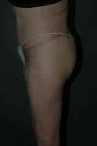 Belt Lipectomy