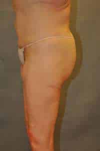 Belt Lipectomy