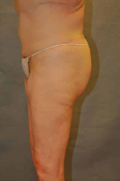Belt Lipectomy